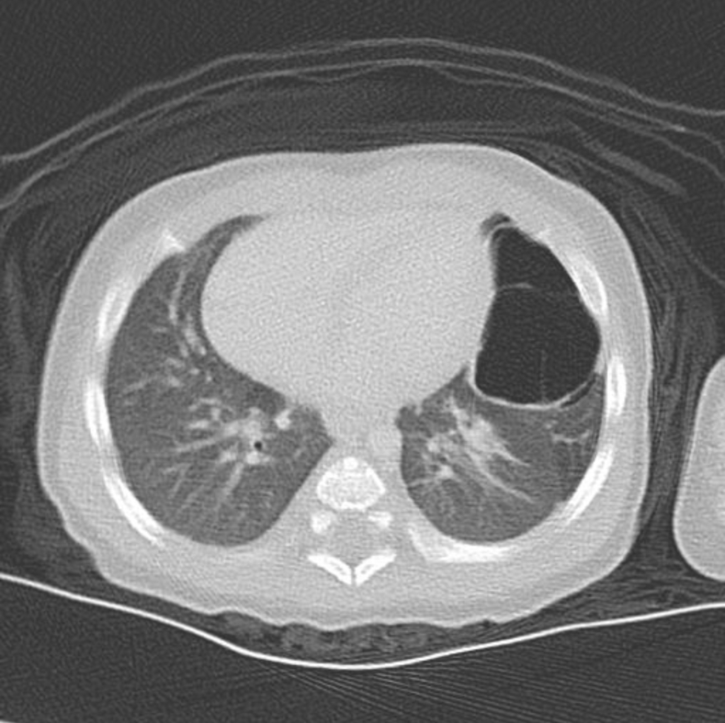 CuringN's tweet photo. Lung - What's your diagnosis?

Topic link: https://t.co/Q31AfBCfUZ

Images contributed by Aliya N. Husain, M.D.

Visit our CCN blog for cancer-related essays by Dr. Pernick: https://t.co/aaLBk9B2jb.

#Cancer #CancerResearch #CuringCancerNetwork #Pathology https://t.co/dUaR18f8RI