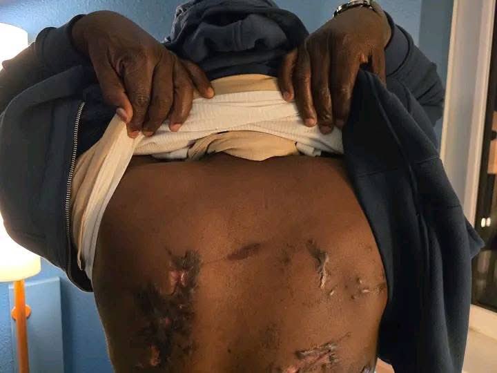 **"The Scars of Cameroon’s Crimes Against Humanity"**

#CRIMES_AGAINST_HUMANITY  

The scars you see on this man’s back tell a story of unimaginable brutality. This man, a victim of *torture* in Buea, the capital of Ambazonia, was abducted by Cameroon’s military and tortured for