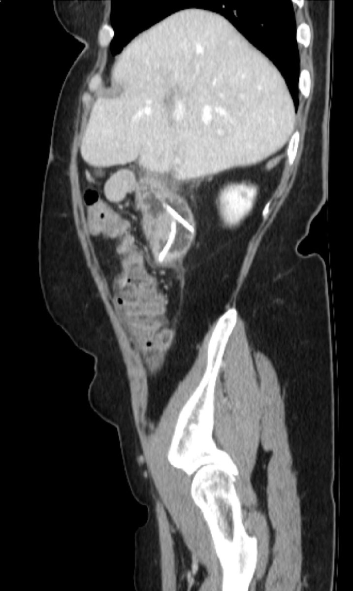 KHS_VIR's tweet photo. Case of the week #5

52 year old female with prior Roux-en-y/hepaticojejunostomy for malignancy, now with migrated biliary stents pinned in jejunum for over one year. https://t.co/jbmGouyTjN