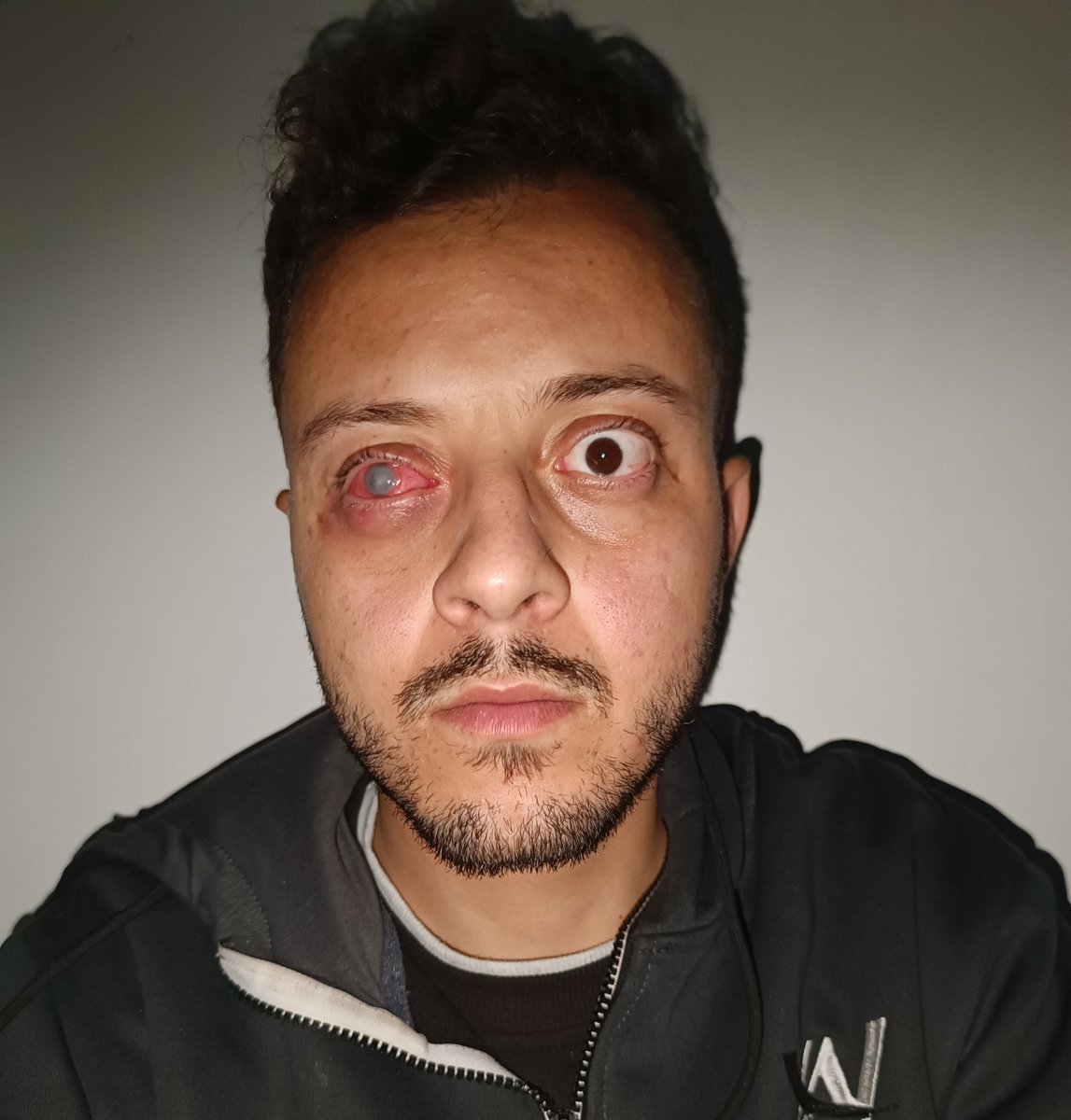 My eye is worse than you see in the picture, you can't imagine the nightmare I live in. 
Please Please Pray for me. 
gofund.me/3fd33d14