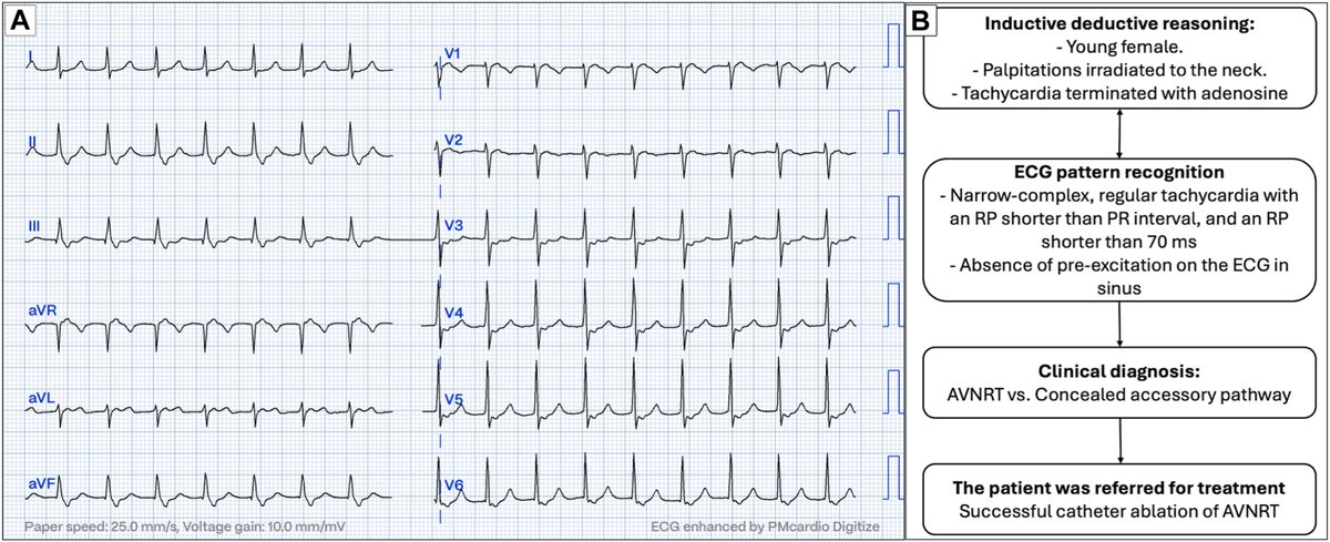 💡 Learn more about how to teach #ECGs through pattern recognition &amp; inductive deductive reasoning 👉 onlinecjc.ca/article/S0828-… #CJC