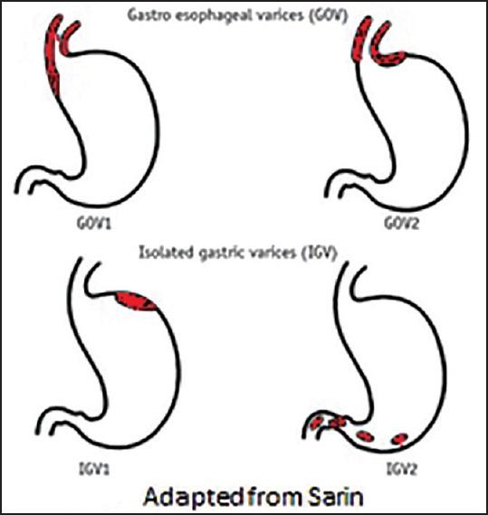 EndoCollabcom's tweet photo. Different types of gastric varices need different approaches

See the attached image for the Sarin classification we use:

💡 Key takeaways:

• Clean view is crucial
• Identify bleeding points
• Choose right technique
• Stay calm during procedure
• Confirm hemostasis

Want to learn more?
https://t.co/2vukdFfJ5Y