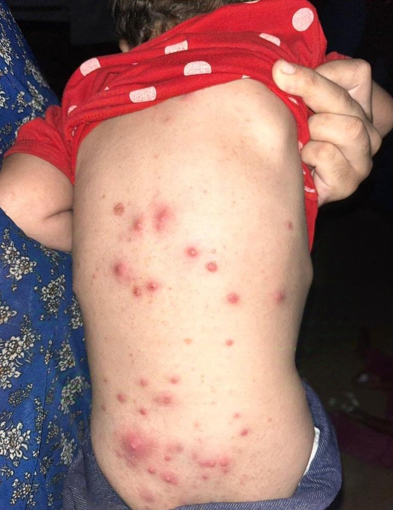 DONT SCROLLING PLEASE , I BEG U

The infection spread throughout
 Nimir's baby girls entire body Namir needs to get her kids out of g@za please help them ASAP
THEIR TREATMENT IS NOT WORKING AND THE WEATHER IS MAKING IT WORSE.
 
HELP ME GET TREATMENT
gofundme.com/f/support-yous…
#BB26