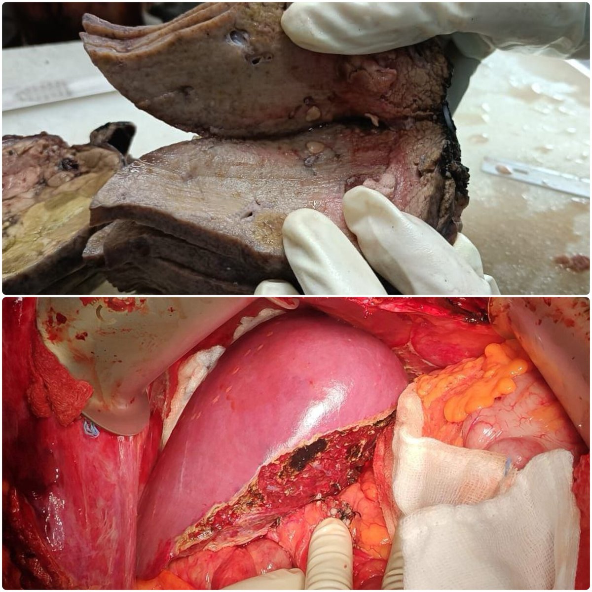theliverdoc's tweet photo. Hello. Just wanted to show the inside of the liver of a 32 year old, "weekends only" alcohol drinking man, and the healthy donor liver of his wife, that he received, that will help him survive to see their little daughter grow up. https://t.co/htCJ0wbOhK