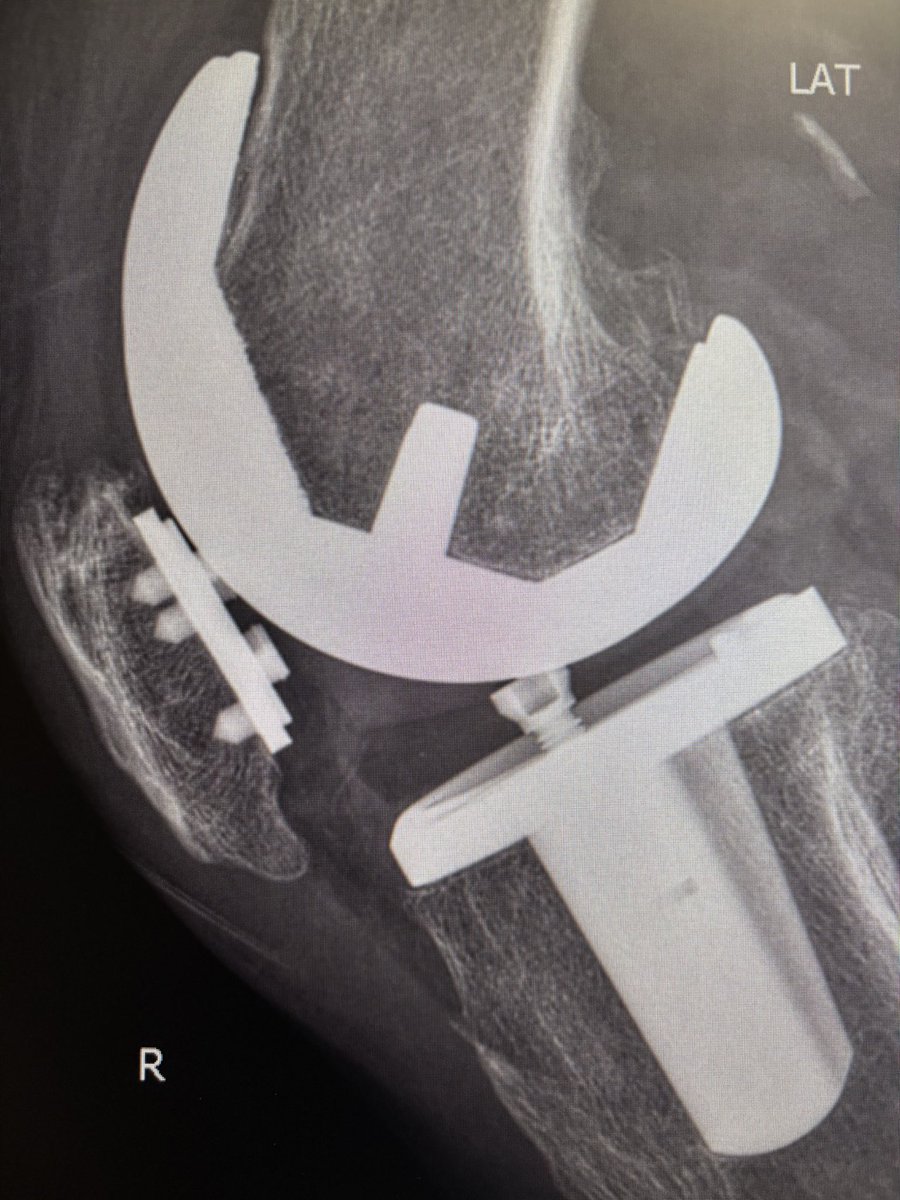 Tibula Doc (@sirmi81) on Twitter photo Does anyone recognize this implant and/or know why there’s a set screw in a primary CR poly?? (Patient has had this for ~15 years, no mechanical symptoms in this knee).
<a href="/aschwartz45/">Andy Schwartz</a> <a href="/jointdocShields/">John Shields, MD, FAAOS</a> <a href="/generalorthomd/">Very General Orthopaedist</a> <a href="/BrianChalmersMD/">Brian Chalmers</a> <a href="/ACR_MD/">Anna Cohen-Rosenblum</a> <a href="/EdinburghKnee/">Chloe EH Scott</a> Does anyone recognize this implant and/or know why there’s a set screw in a primary CR poly?? (Patient has had this for ~15 years, no mechanical symptoms in this knee).
<a href="/aschwartz45/">Andy Schwartz</a> <a href="/jointdocShields/">John Shields, MD, FAAOS</a> <a href="/generalorthomd/">Very General Orthopaedist</a> <a href="/BrianChalmersMD/">Brian Chalmers</a> <a href="/ACR_MD/">Anna Cohen-Rosenblum</a> <a href="/EdinburghKnee/">Chloe EH Scott</a>