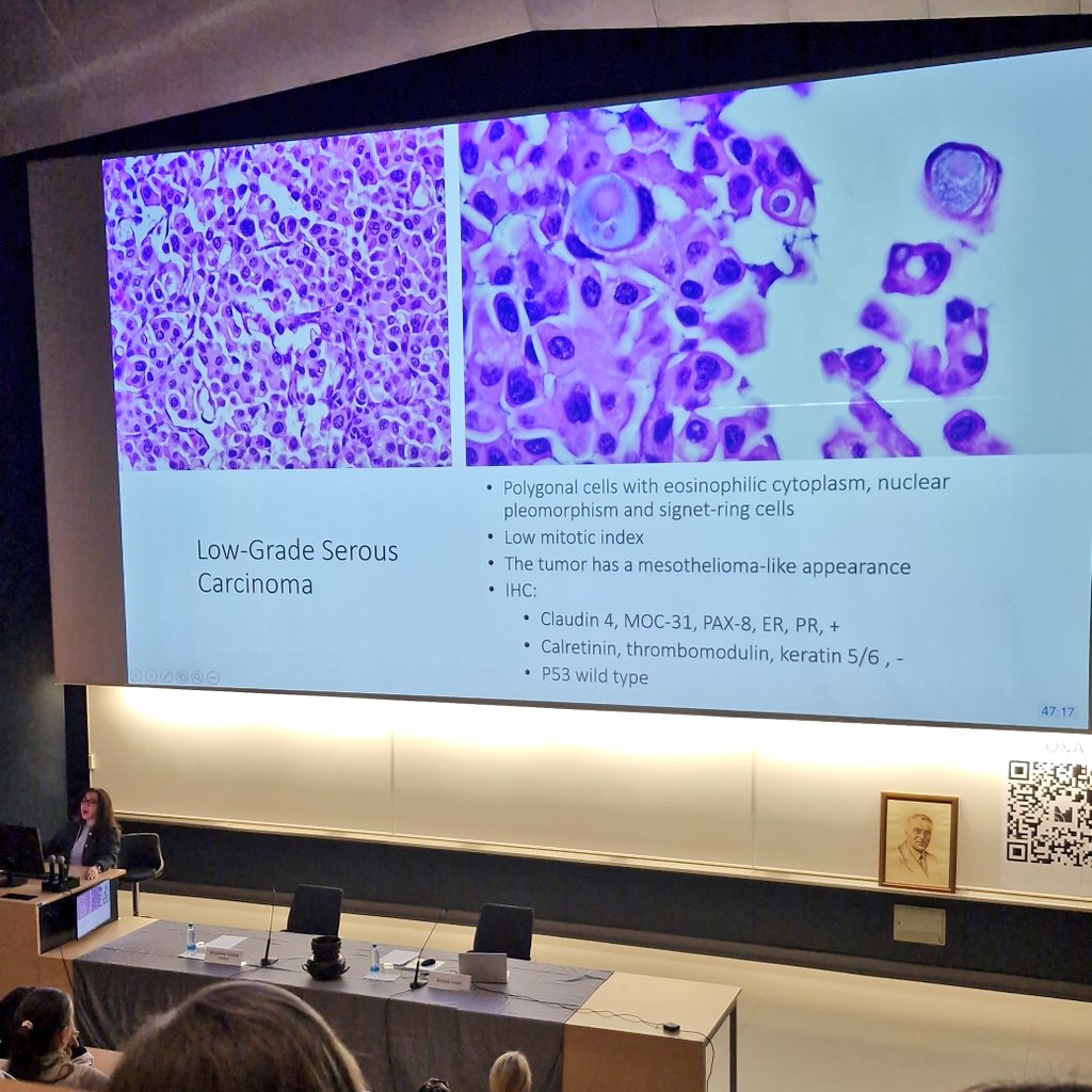 zivaledinek's tweet image. Some #NaughtyCases of low-grade serous carcionoma aka "tumours which don't follow the rules" by @AnaisMalpica ... my take 🏡✉️ is to always expect the unexpected 😅🔬 #PathTrainee #PathX