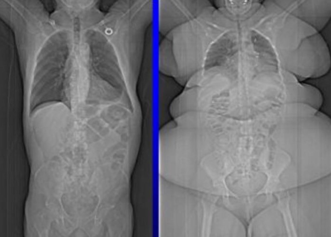 معالجة السمنة تقلل خطر الأمراض بلا شك .. 
لكن يترتب عليها أيضاً مكاسب غير ملموسة لا يشعر بها إلا من تخلص من السمنة .. 

١- ثقة اكبر في الإنجاز و تحقيق الأهداف .. 
٢- فرص وظيفية اكثر .. 
٣- فرص عاطفية أكثر .. 
٤- قدرة على المشاركة في نشاطات حركية .. 
٥- وقت اكبر للعمل و الإنتاج ..