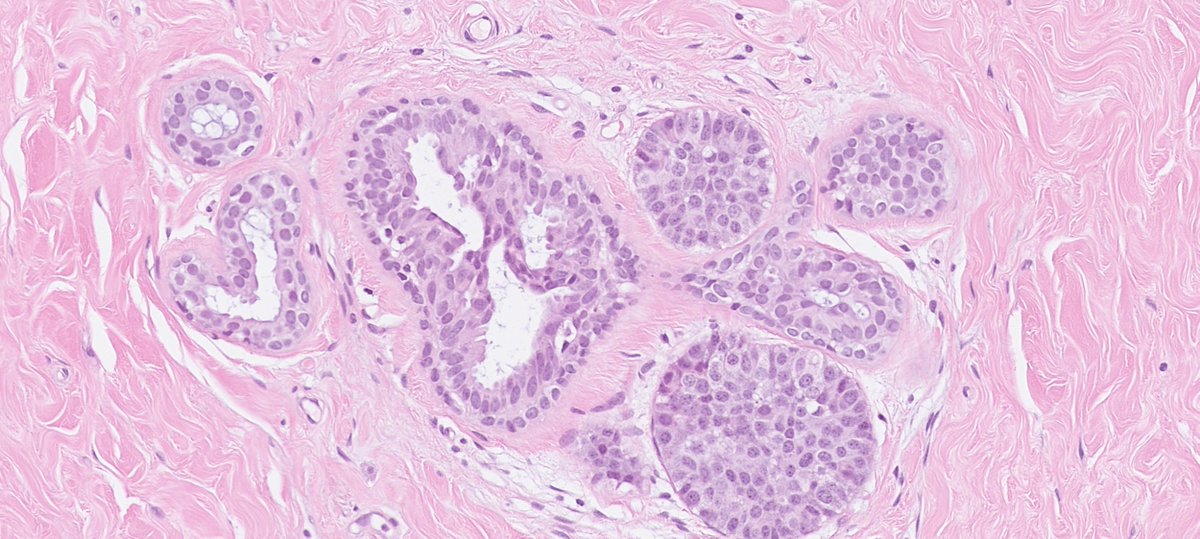 DrJuhlin's tweet photo. 50:ish y/o F, left breast, lumpectomy. Answer the poll first before scrolling further! https://t.co/ncXwiwgJHP