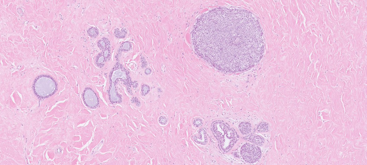 DrJuhlin's tweet photo. 50:ish y/o F, left breast, lumpectomy. Answer the poll first before scrolling further! https://t.co/ncXwiwgJHP