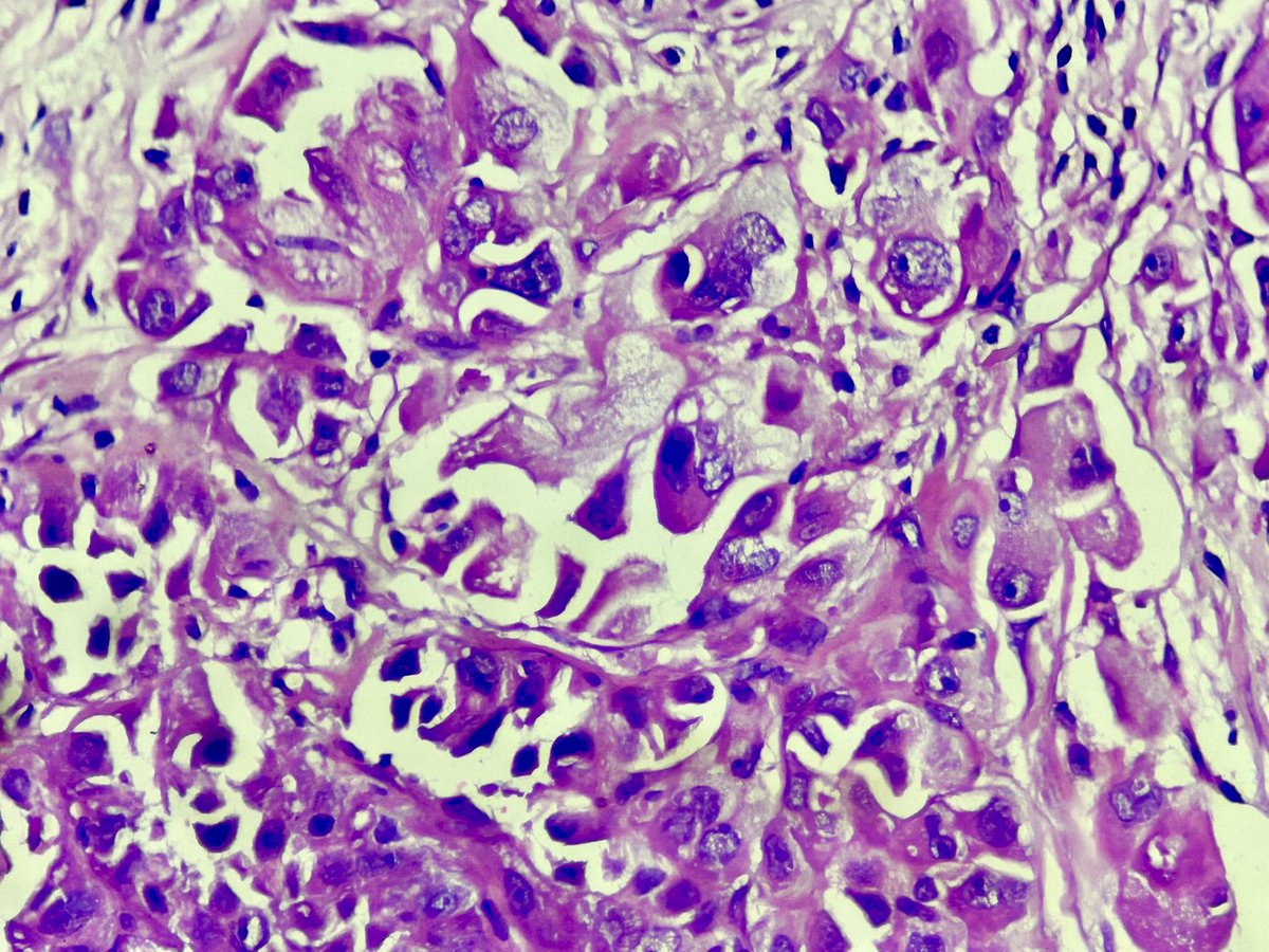 drlachit's tweet photo. Malignant mesothelioma in a 60 year old man. H/O pleural thickening. 
#pathology #histopathology #pulomnarypathology #ilovepathology https://t.co/ZtcbhuUIIy