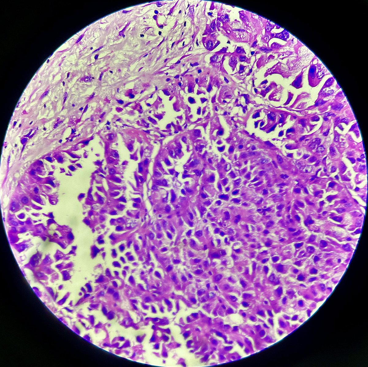 drlachit's tweet photo. Malignant mesothelioma in a 60 year old man. H/O pleural thickening. 
#pathology #histopathology #pulomnarypathology #ilovepathology https://t.co/ZtcbhuUIIy