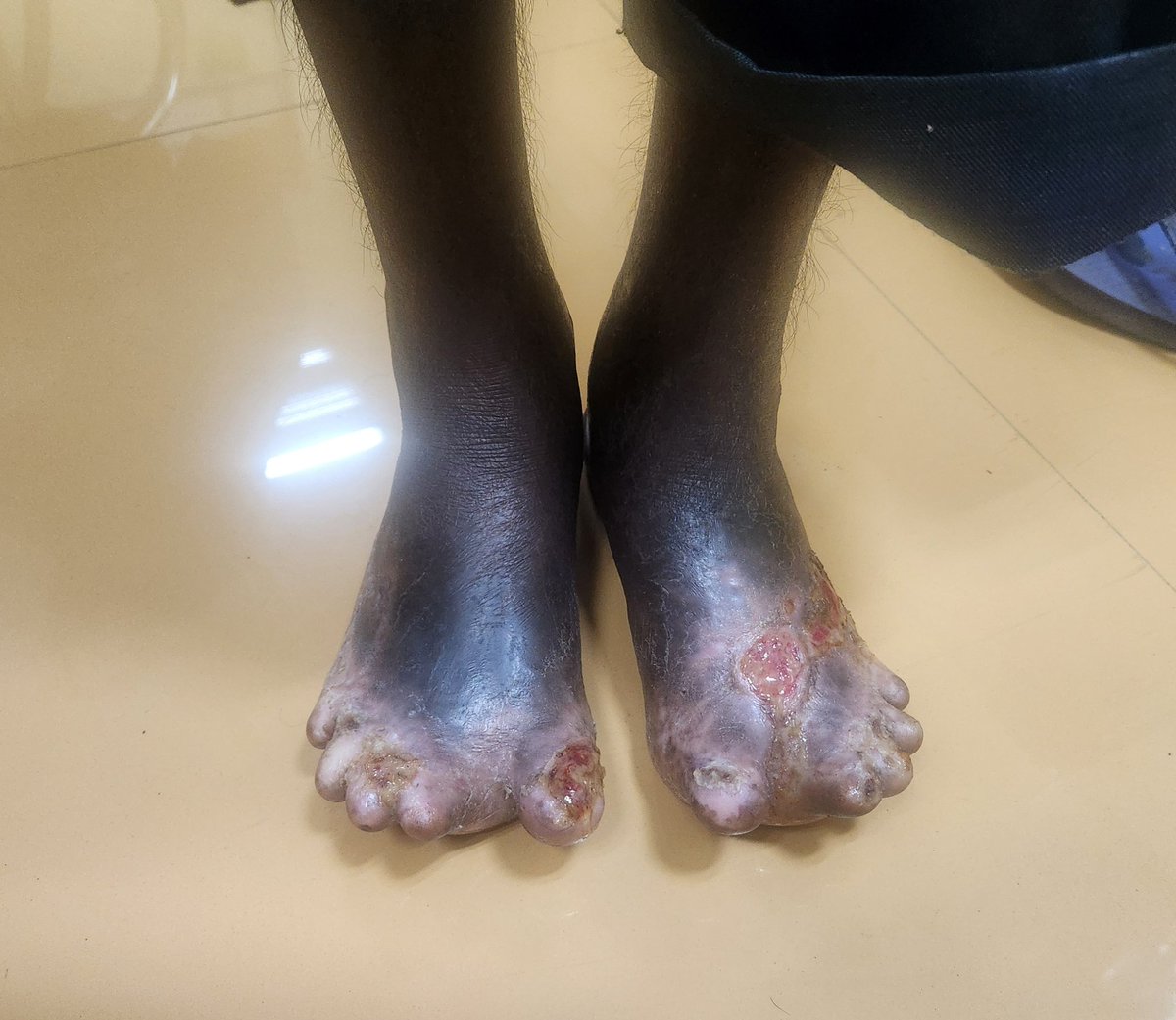 Dr Priti MD,FASN🇮🇳 (प्रिति) tweet media