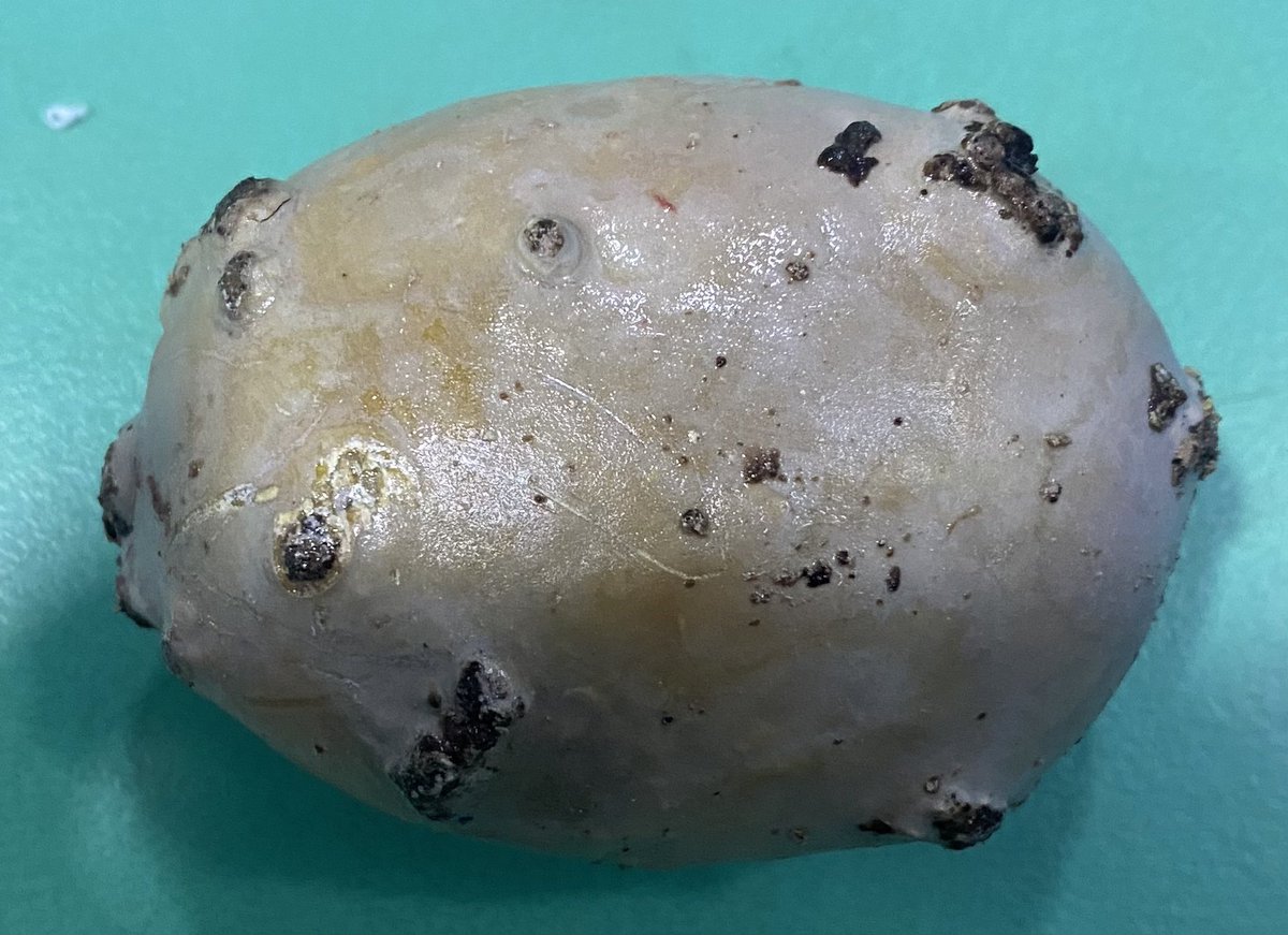 drrobinbasnet's tweet photo. This is not a potato … 9x6 cm bladder stone !! https://t.co/rp8W2GgymK
