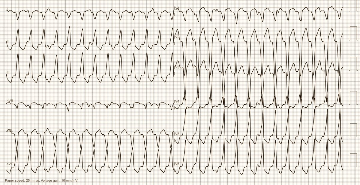 ecgandrhythmRoe's tweet photo. This ECG was sent to me with the question: SVT or VT? https://t.co/ubNVVmgEcX