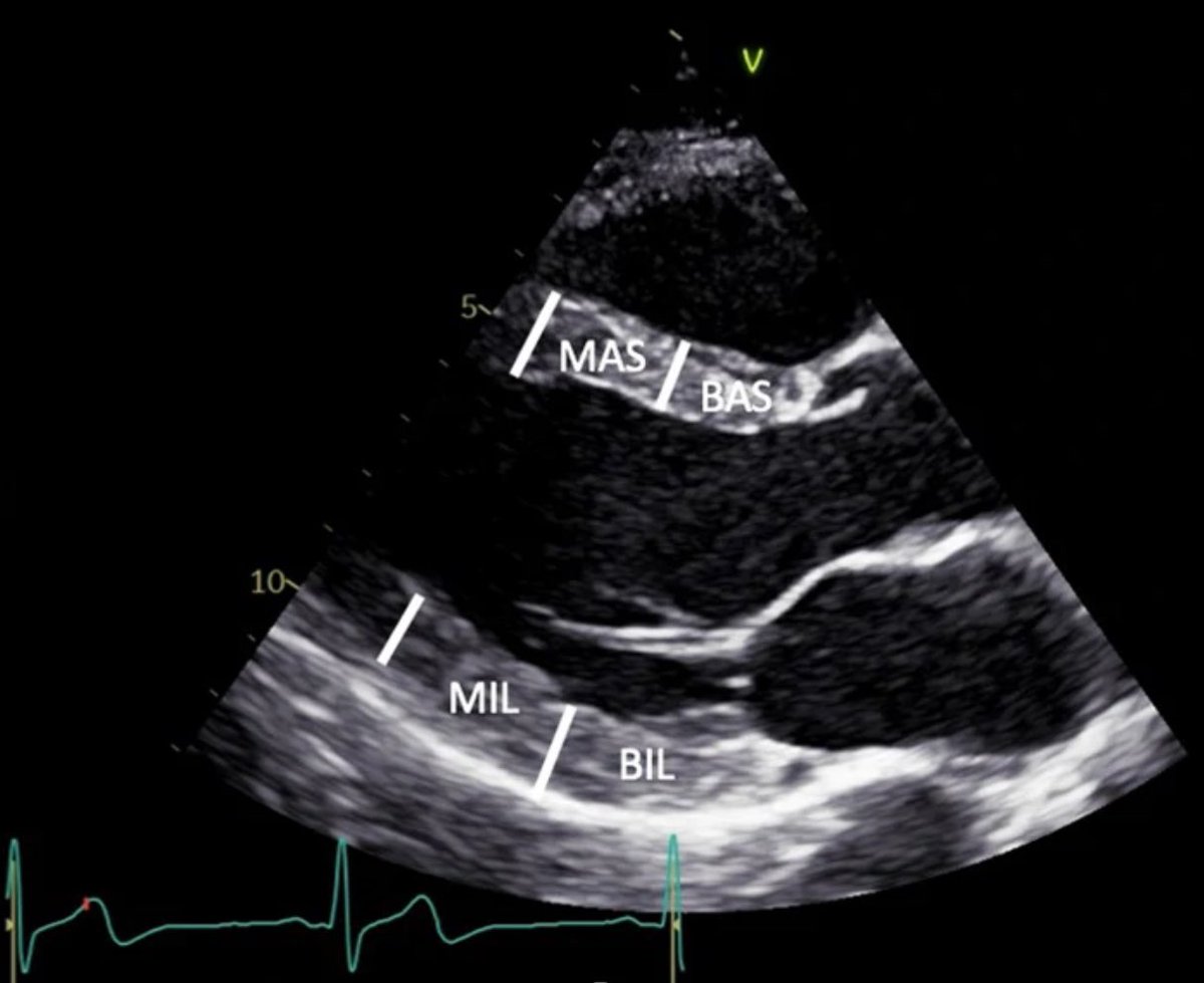 POCUSpeek's tweet image. #firstecho #MedEd #POCUS from @BSEcho 

BAS: Basal antero-septum
MAS: Mid antero-septum
BIL: Basal infero-lateral
MIL: Mid infero-lateral