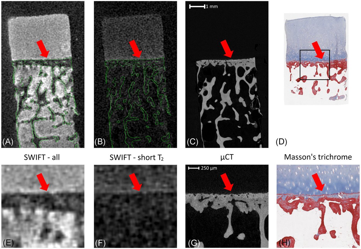 Ausilah Alfraihat, PhD (@ausialfraihat) on Twitter photo Where do hyperintense signals in osteochondral junctions originate? A study <a href="/JOrthopRes/">Journal of Orthopaedic Research®</a> shows that ultrashort echo time SWIFT MRI signals arise from noncalcified cartilage, affected by rapid T1 relaxation and susceptibility effects. #ORSSML @ORSSociety doi.org/10.1002/jor.24… Where do hyperintense signals in osteochondral junctions originate? A study <a href="/JOrthopRes/">Journal of Orthopaedic Research®</a> shows that ultrashort echo time SWIFT MRI signals arise from noncalcified cartilage, affected by rapid T1 relaxation and susceptibility effects. #ORSSML @ORSSociety doi.org/10.1002/jor.24…