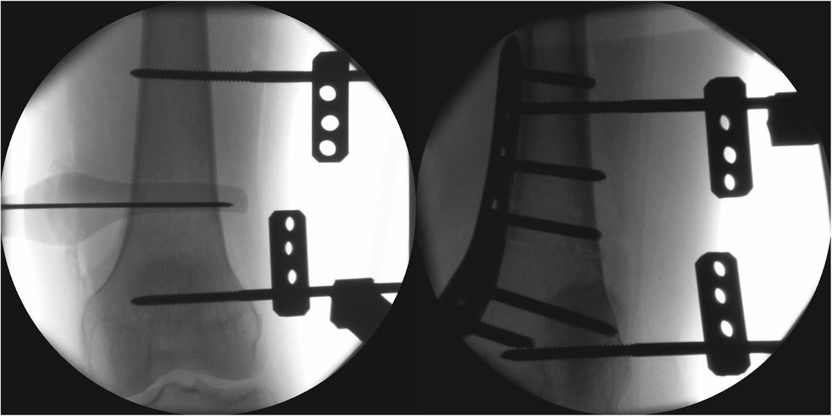 Ausilah Alfraihat, PhD (@ausialfraihat) on Twitter photo Struggling with femur malalignment during osteotomies? A radiography-based navigation tool shows promise in correcting torsional malalignment with minimal deviation. Could this be the future of precise treatments?
<a href="/JOrthopRes/">Journal of Orthopaedic Research®</a> #ORSSML @ORSSociety doi.org/10.1002/jor.24… Struggling with femur malalignment during osteotomies? A radiography-based navigation tool shows promise in correcting torsional malalignment with minimal deviation. Could this be the future of precise treatments?
<a href="/JOrthopRes/">Journal of Orthopaedic Research®</a> #ORSSML @ORSSociety doi.org/10.1002/jor.24…