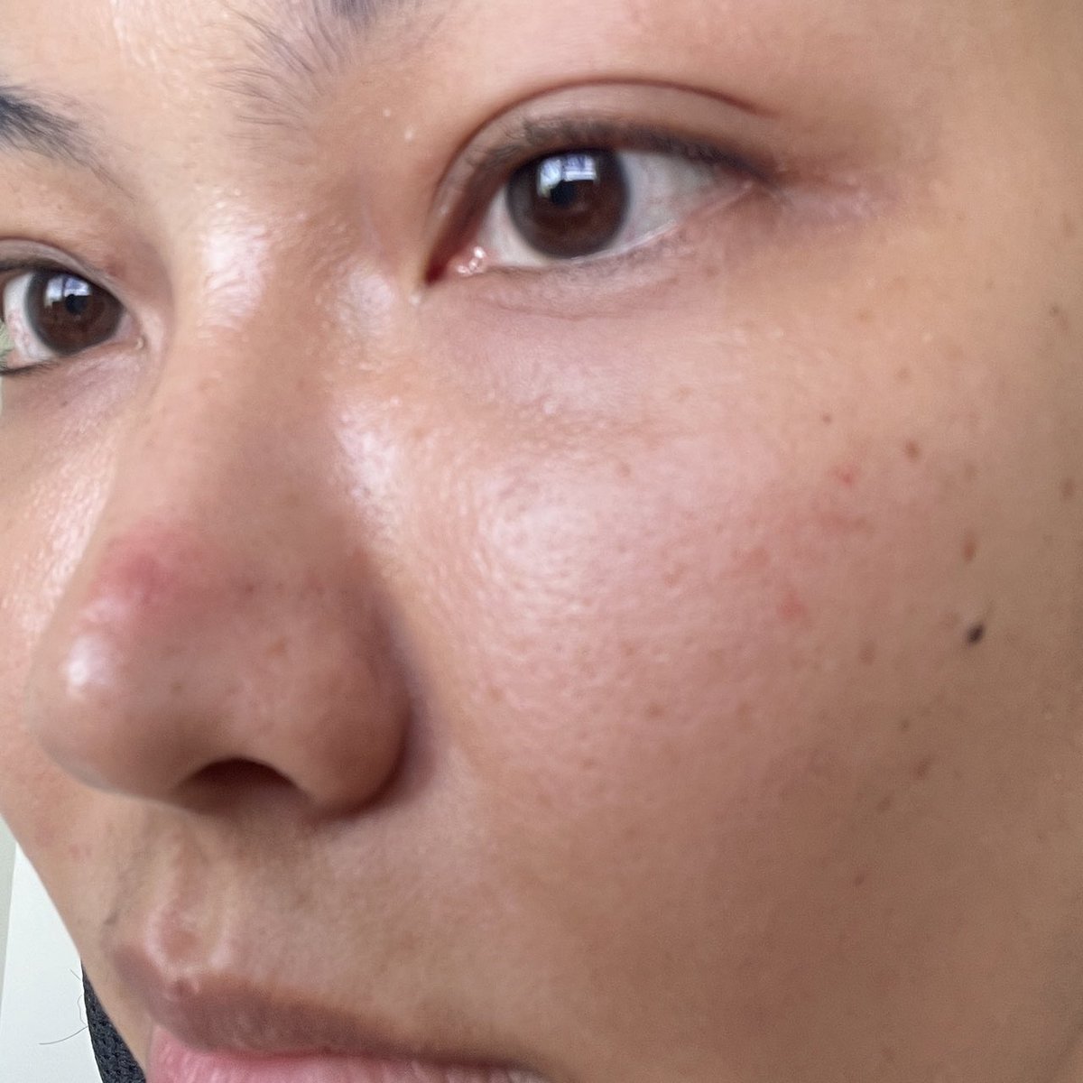 La Roche-Posay ไม่มาเล่นๆฮะ ก่อนออกงานที่ต้องใช้หน้าคือคุณสิวจะมารู้เวลาตลอด บิวได้ Effaclar Duo+M สูตรใหม่มาลองพอดี ใช้ก่อนนอน 8 ชั่วโมง ตื่นมาสิวก็เริ่มแห้งละฮับ คือเค้ารีเสิร์ชมาแล้วว่าการเสียสมดุลของแบคทีเรีย C.Acnes( 1A1) ซึ่งเป็นตัวก่อให้เกิดสิว ตัวนี้มี Phylobioma ช่วยจัดเรื่องสิว ปรับสมดุลแบคทีเรียบนผิว ลดความมันส่วนเกิน เนื้อสัมผัสดี ซึมไว ใช้แล้วสิวดูจางลง ผิวเรียบเนียนขึ้น สูตรนี้รอยแดงยุบไวกว่าสูตรเดิมด้วย แนะนำงับ 
หาซื้อได้ตาม WATSONS, BOOTS, EVEANDBOY, BEAUTRIUM, LAZADA, SHOPEE, KONVY, CENTRAL ONLINE เลยค่ะ
#LaRochePosayTH