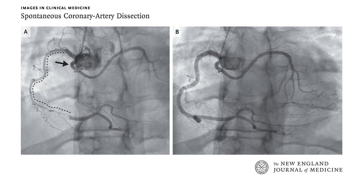 NEJM (@nejm) on Twitter photo A 32-year-old woman presented with severe chest pain. An ECG showed ST-segment elevations. Coronary angiography showed an abrupt caliber change in the right coronary artery (shown in a video). Full case details from <a href="/MontefioreNYC/">Montefiore Health System</a>: nej.md/49p7JQI A 32-year-old woman presented with severe chest pain. An ECG showed ST-segment elevations. Coronary angiography showed an abrupt caliber change in the right coronary artery (shown in a video). Full case details from <a href="/MontefioreNYC/">Montefiore Health System</a>: nej.md/49p7JQI