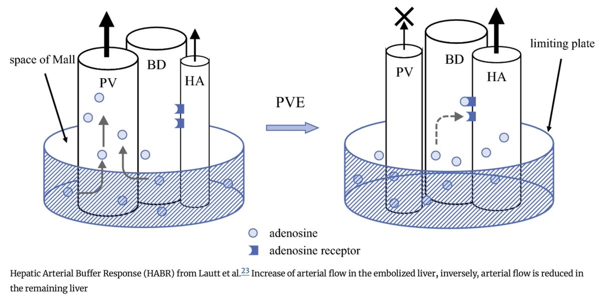 Annals of Surgical Oncology (@annsurgoncol) on Twitter photo December Issue: Comprehensive Review of Future Liver Remnant (FLR) Assessment and Hypertrophy Techniques Before Major #Hepatectomy : How to Assess and Manage the FLR
rdcu.be/d2zsp
<a href="/CamilleLStewart/">Camille Stewart, MD</a>
<a href="/SyedAAhmad5/">Syed A. Ahmad</a> December Issue: Comprehensive Review of Future Liver Remnant (FLR) Assessment and Hypertrophy Techniques Before Major #Hepatectomy : How to Assess and Manage the FLR
rdcu.be/d2zsp
<a href="/CamilleLStewart/">Camille Stewart, MD</a>
<a href="/SyedAAhmad5/">Syed A. Ahmad</a>