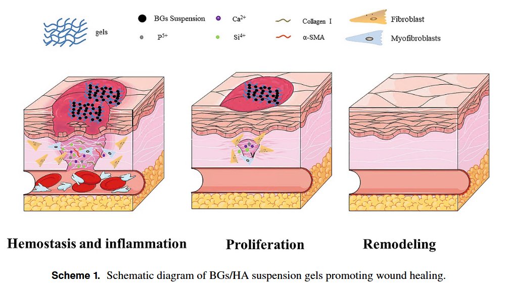 IOP Nano (@iopnano) on Twitter photo Bioactive glass suspension hydrogel
promotes wound healing by modulating
fibroblasts
In this excellent paper by H. Zhu et al <a href="/hubeiuni/">Hubei University</a> , the use of BG Hydrogels to expediate wound healing and reduce the amount of pathological scar formation is discussed.
iopscience.iop.org/article/10.108… Bioactive glass suspension hydrogel
promotes wound healing by modulating
fibroblasts
In this excellent paper by H. Zhu et al <a href="/hubeiuni/">Hubei University</a> , the use of BG Hydrogels to expediate wound healing and reduce the amount of pathological scar formation is discussed.
iopscience.iop.org/article/10.108…