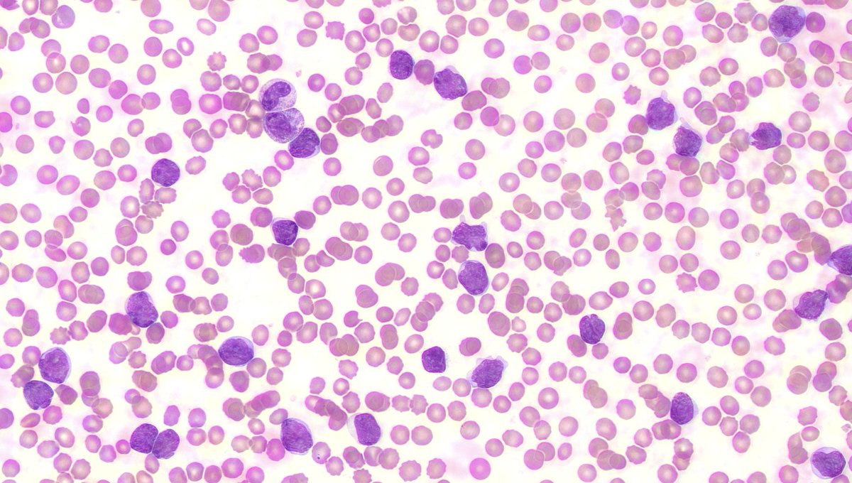 While <a href="/nihardesai89/">𝗡𝗶𝗵𝗮𝗿 𝗗𝗲𝘀𝗮𝗶 MD, DM</a> enjoys #ASH24 with all that sunshine 
Some of us still have to keep the shop floor running

This Poor patient has presented with Pancytopenia 
Peripheral Blood film 👇
What do you think :)
#medicine #medtwitter #meded #hematology #blooducation <a href="/HaemBytes/">HaemBytes</a>