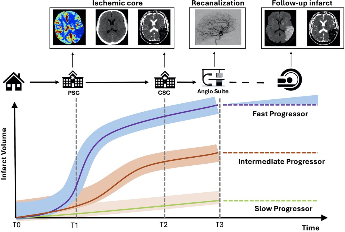 Stroke AHA/ASA (@strokeaha_asa) on Twitter photo #STROKE: This topical review by <a href="/UPensato/">Umberto Pensato MD 🇮🇹 🇨🇦</a> et al. offers a nuanced understanding of infarct growth rate, stroke progressor phenotypes, and their clinical implications. #AHAJournals
ahajournals.org/doi/abs/10.116…
<a href="/bijoymenon/">Bijoy K Menon</a> <a href="/NguyenThanhMD/">Thanh Nguyen 🇺🇦</a> <a href="/BroocksGabriel/">Gabriel Broocks</a> <a href="/mihill68/">Michael D Hill</a> <a href="/johanna_ospel/">Johanna Ospel, MD PhD</a> #STROKE: This topical review by <a href="/UPensato/">Umberto Pensato MD 🇮🇹 🇨🇦</a> et al. offers a nuanced understanding of infarct growth rate, stroke progressor phenotypes, and their clinical implications. #AHAJournals
ahajournals.org/doi/abs/10.116…
<a href="/bijoymenon/">Bijoy K Menon</a> <a href="/NguyenThanhMD/">Thanh Nguyen 🇺🇦</a> <a href="/BroocksGabriel/">Gabriel Broocks</a> <a href="/mihill68/">Michael D Hill</a> <a href="/johanna_ospel/">Johanna Ospel, MD PhD</a>