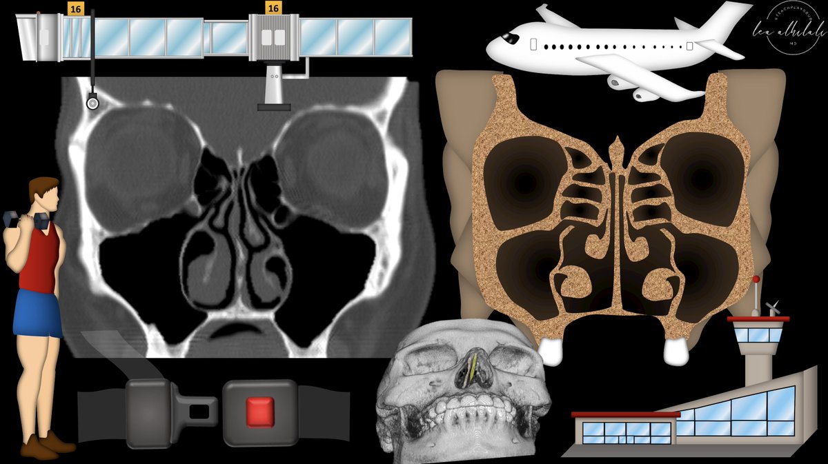 1/Time to FESS up! Do you understand functional endoscopic sinus surgery (FESS)?

If you read sinus CTs, you better know what the surgeon is doing or you won’t know what you’re doing!

Here’s a thread to make sure you always make the important findings!