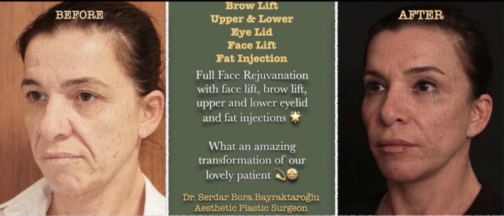 Clinicsbbintl's tweet photo. BROW LIFT/ UPPER & LOWER EYE LID/ FACE LIFT/ FAT INJECTION
You can get rid of the tired appearance of aging with all facial rejuvenation.
#beforeafter #browlift #uppereyelidsurgery #lowereyelidsurgery #facelift #fatinjection #fullfacerejuvenation #brow #face https://t.co/T3QYRQyiZV