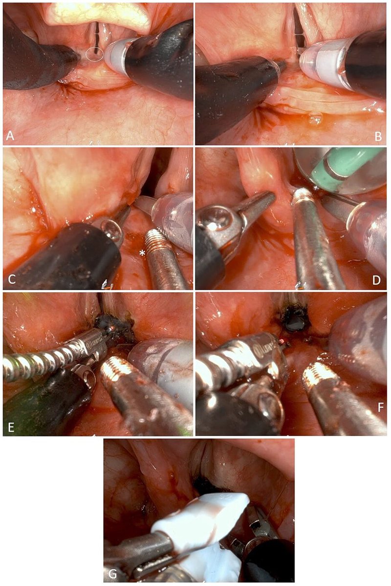 Robotics in laryngeal surgery needs advancement. Potential benefits (tremor stabilization, more ergonomic tissue handling) are very pertinent.  Our pub about a TORS PGS lysis and arytenoidectomy. <a href="/IntuitiveSurg/">Intuitive</a> <a href="/WashUMedENT/">WashUMedENT</a> <a href="/UAB_OTO/">UAB Otolaryngology</a> 
journals.sagepub.com/doi/10.1177/00…