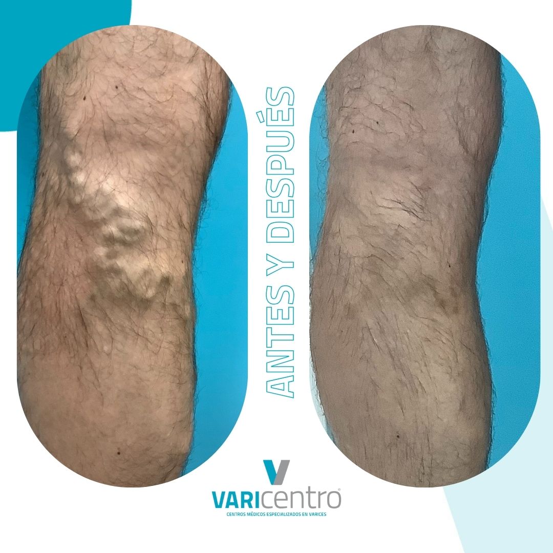 Varicentro's tweet photo. ✅ Sin cirugía.
✅ Sin baja laboral.
✅ Sin dejar de realizar sus actividades cotidianas.

Si quieres más información puedes contactar con nosotros en

☎️ 912 77 88 99 o en
🖥 https://t.co/PAO1p9rb4A

#varices #tratamientodevarices #eliminarvarices #sinvarices #espumaesclerosante https://t.co/ArVFd7qUSS