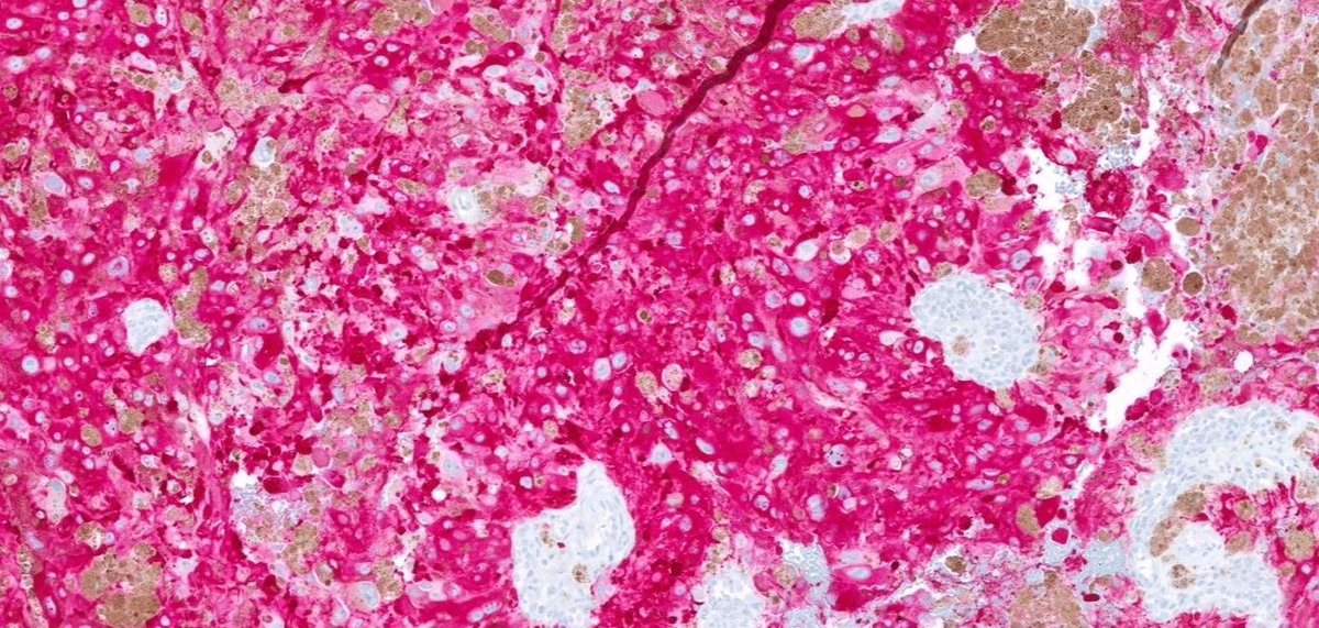 Malignant melanotic nerve sheath tumor (MMNST): heavily pigmented, pleomorphic, SOX10/Melan-A positive (shown), often paraspinal in younger patients. Key to distinguish from melanoma—MMNST frequently has PRKAR1A inactivation. #BSTpath #Dermpath