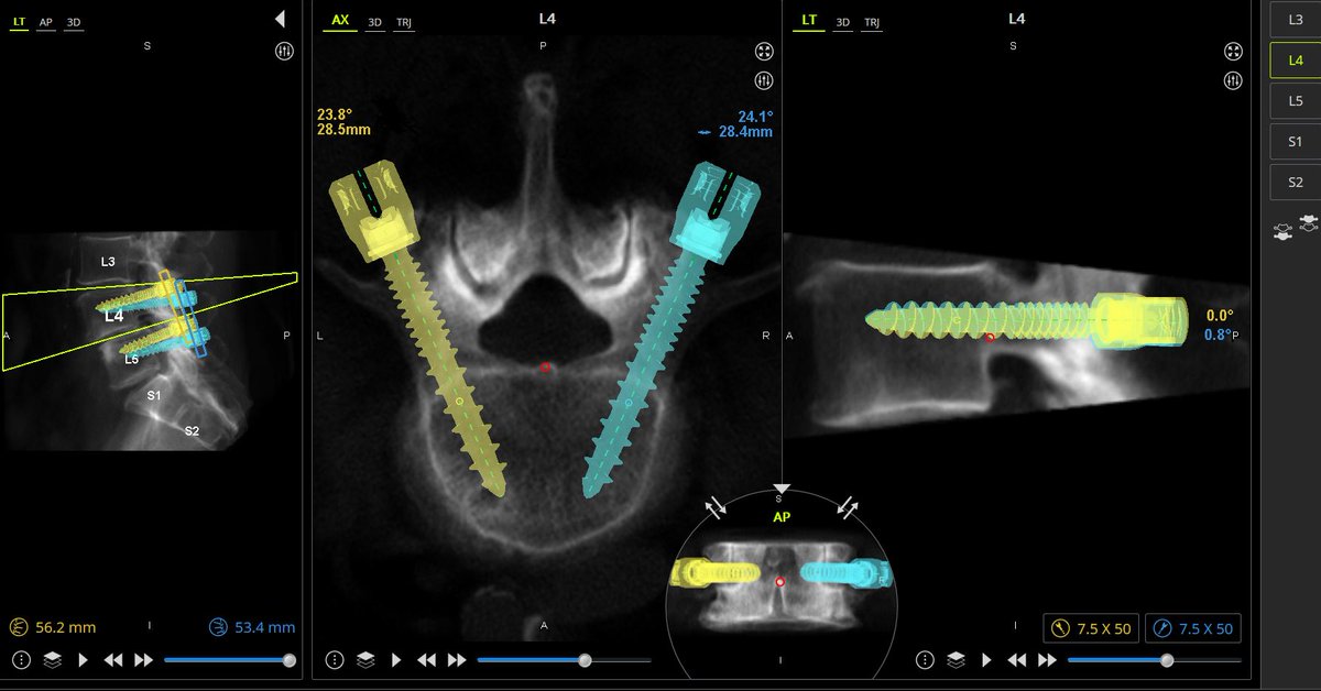 An HSS study comparing robotic-assisted navigation to the use of augmented reality in #spine surgery found that both techniques demonstrate excellent accuracy and safety for pedicle screw placement. 

news.hss.edu/study-compares…