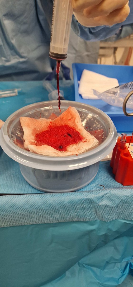 Mechanical Thrombectomy Team NUH (@thrombectomynuh) on Twitter photo Actual blood clot from a stroke patient with right ICA-T occlusion, presented with left sided weakness, sensory loss, visual neglect and slurring of speech. 
Changing lives with #mechanicalthrombectomy <a href="/nottmhospitals/">Nottingham University Hospitals</a> Actual blood clot from a stroke patient with right ICA-T occlusion, presented with left sided weakness, sensory loss, visual neglect and slurring of speech. 
Changing lives with #mechanicalthrombectomy <a href="/nottmhospitals/">Nottingham University Hospitals</a>