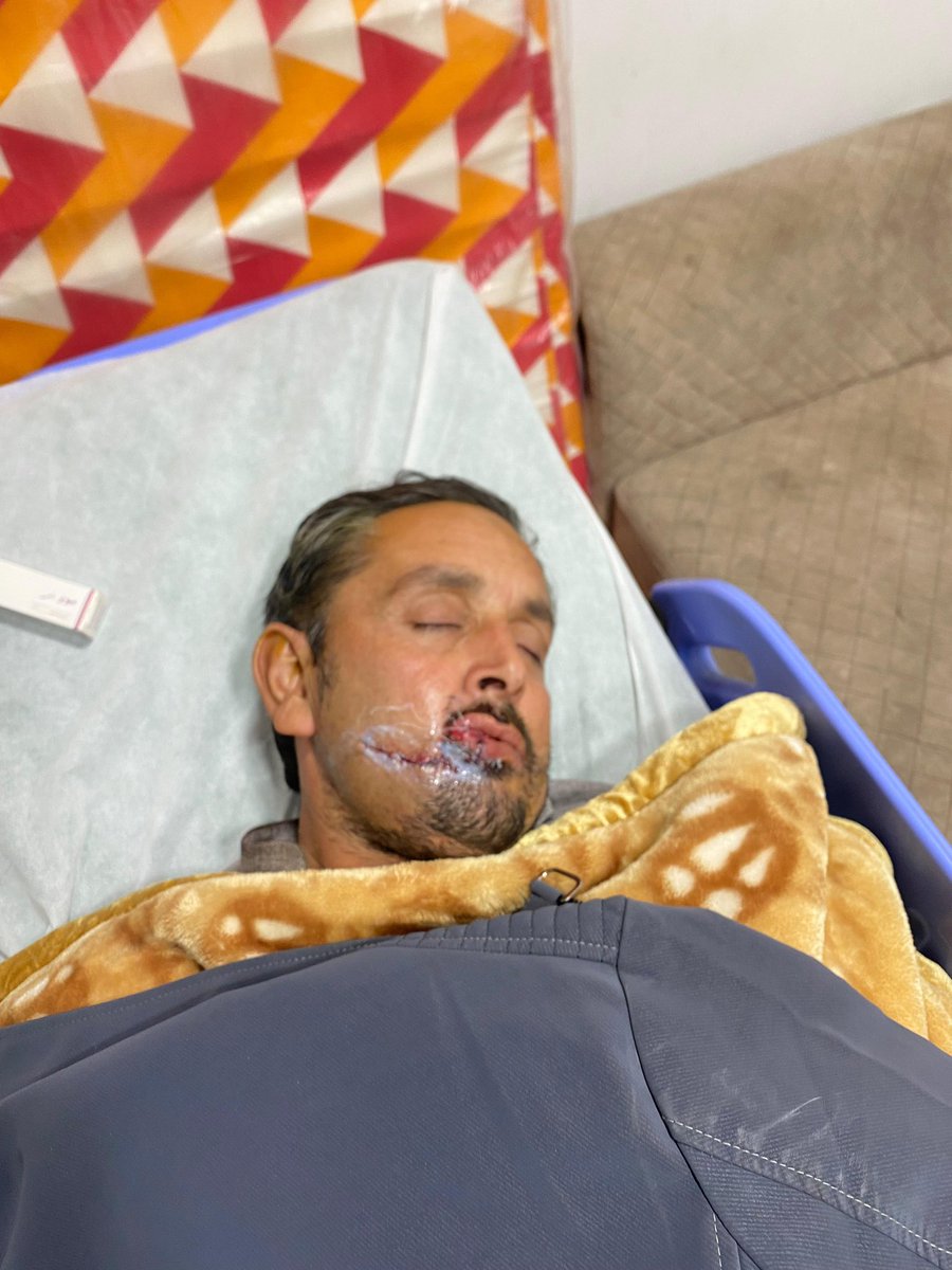 PTIofficial's tweet photo. ہمارے  نہتے، پرامن، کارکن عمران (درگئی) کو ڈی چوک میں منہ پرسنائپرسے گولی ماری گئی تھی۔

الحمداللہ آج پہلی سرجری مکمل ہوگئی ہے۔ معاون خصوصی پیر مصور بطور حلقہ نمائندہ تمام تر ذمہ داریاں دیکھ رہے ہیں۔

#گولی_کیوں_چلائی
#IslamabadMassacare https://t.co/d1iq2G4kAk