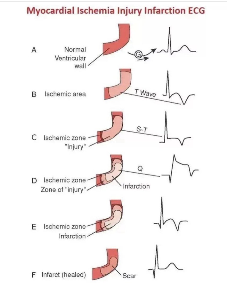 Heart ischemia and EKG