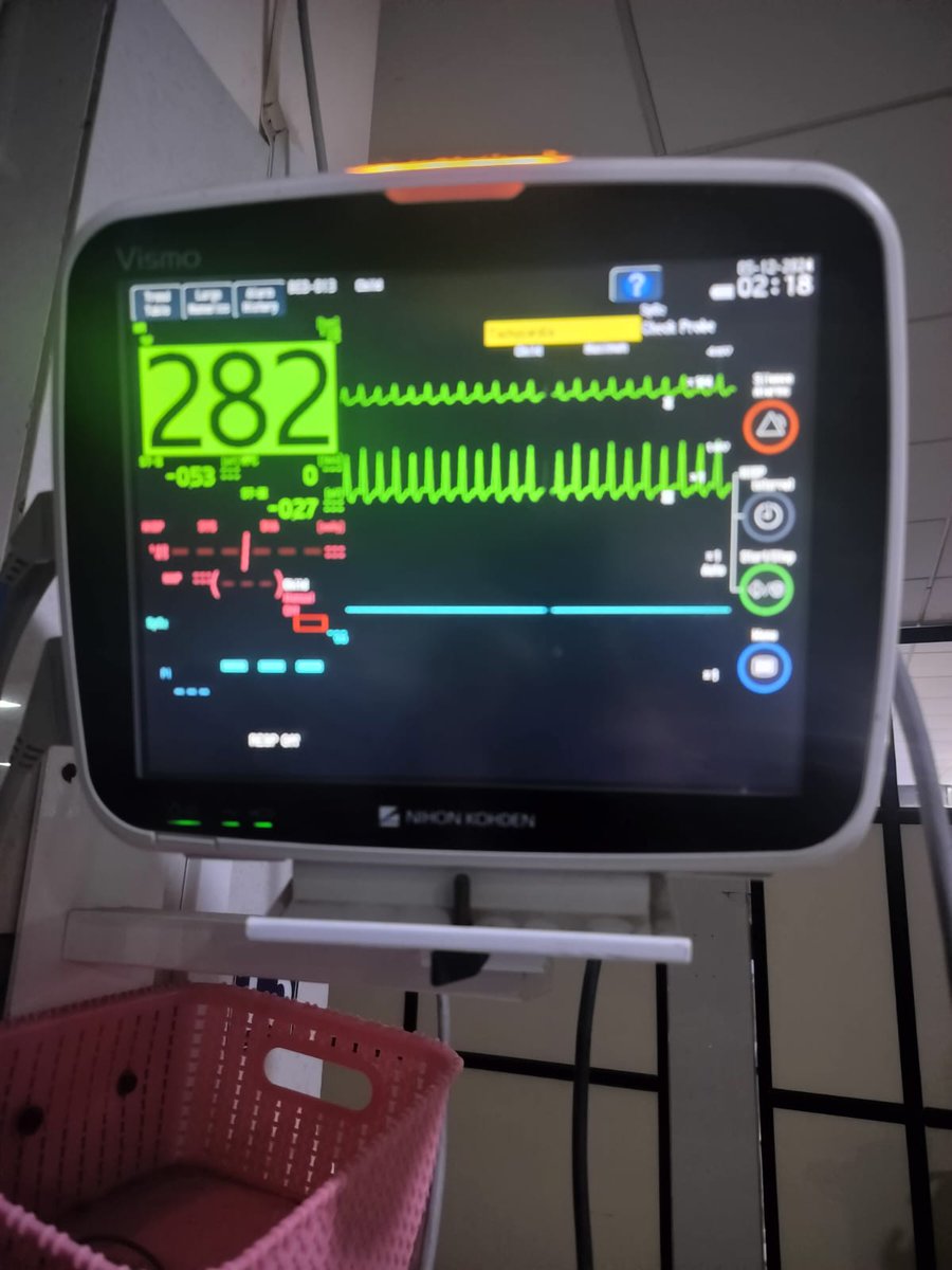 adit_2506's tweet photo. @ecgandrhythmRoe I have this 35 days old infant with svt in picu Cause still unknown. It was very cool when we cardioverted using adenosine. https://t.co/DhllAV7VXA