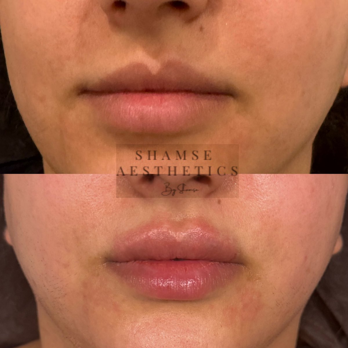 shamseal's tweet photo. Lip Fillers at ShamseAesthetics 0.5ml natural and symmetrical

Ground Floor, 4 Harley Street, W1G 9Pb

#shamseaesthetics #Shamse #aesthetics #fyp #pharmacist #pharmacy #clinic #facelift #harleystreet #fyp #botox #filler #aesthetics #skin #skincare #facetracking #clean #cleantok https://t.co/MjcAYGcSwG