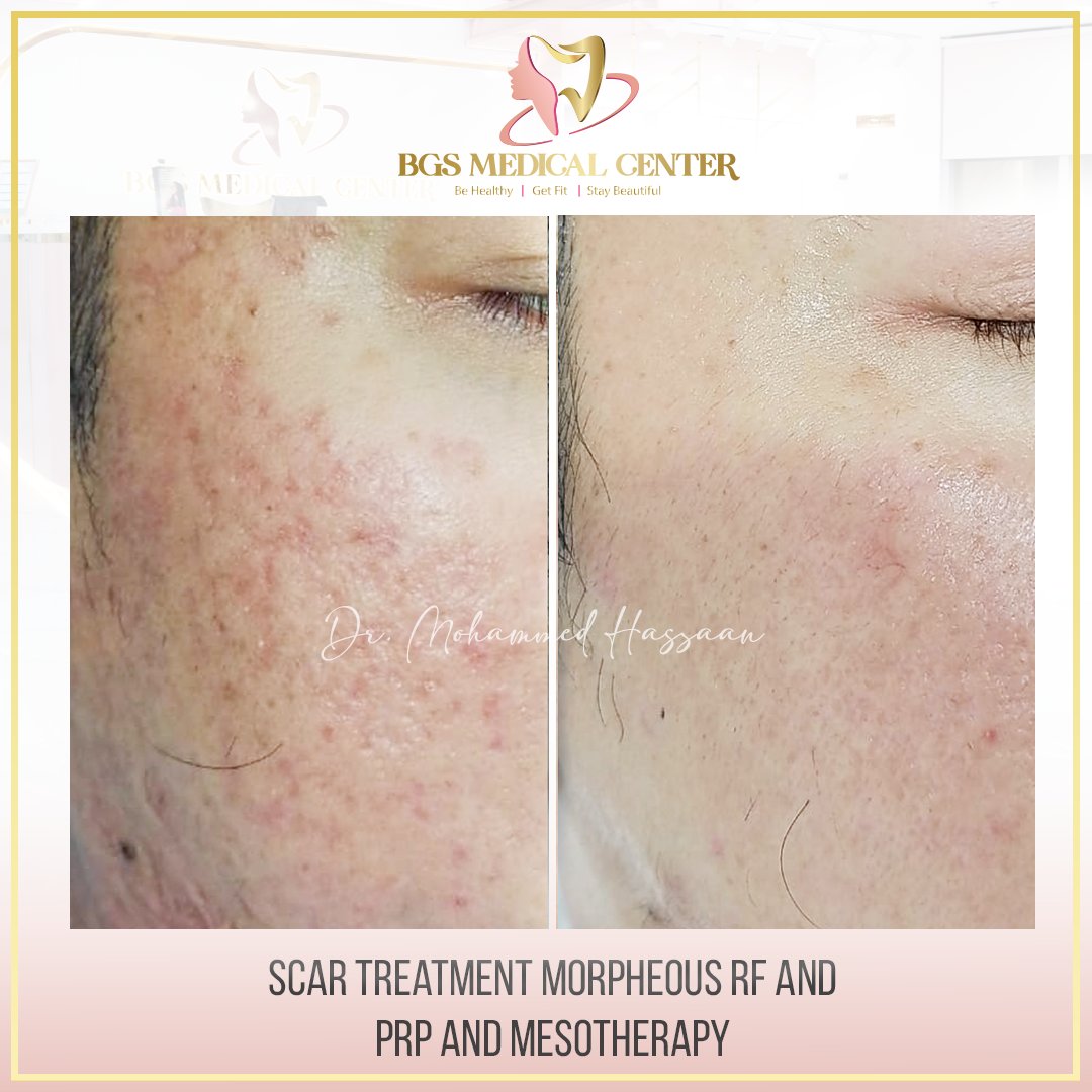 BgsMedical's tweet photo. Witness this stunning transformation with Morpheus RF, PRP, and Mesotherapy performed by Dr. Mohammed Hazzaan at

📞 +971 52 235 9090
🌐 https://t.co/noJiMmOCcO
.
.
.
#ScarTreatment #MorpheusRF #PRPTherapy #Mesotherapy #DrMohammedHazzaan #BGSMedicalCenter https://t.co/CAbbX6z0Sm