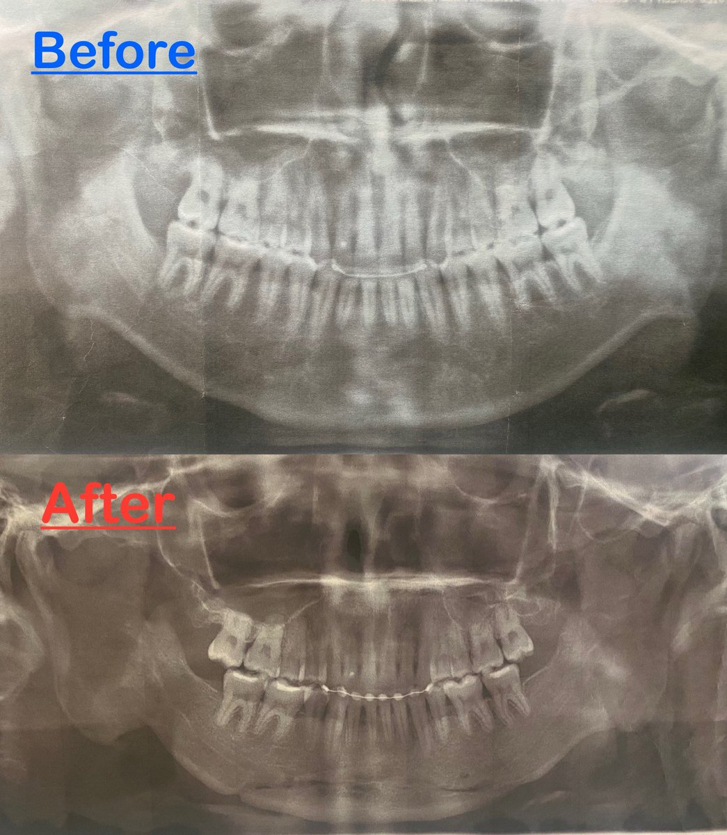 Y03Tf's tweet photo. ◯大BeforeAfter
#顎変形症 #口腔外科 #口腔外科認定指導医 #大学病院 https://t.co/PNKu38mZOh