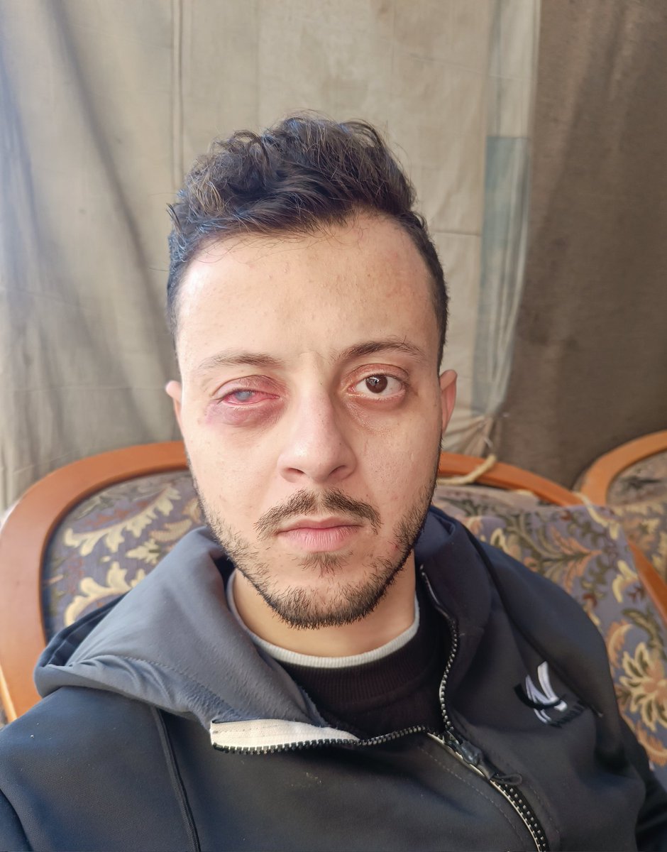 ahmedshameya995's tweet photo. I told the doctor to book for surgery to remove my eye ASAP.
PRAY For Me. 
https://t.co/GJsRia6uPt https://t.co/Ymer26KQOY