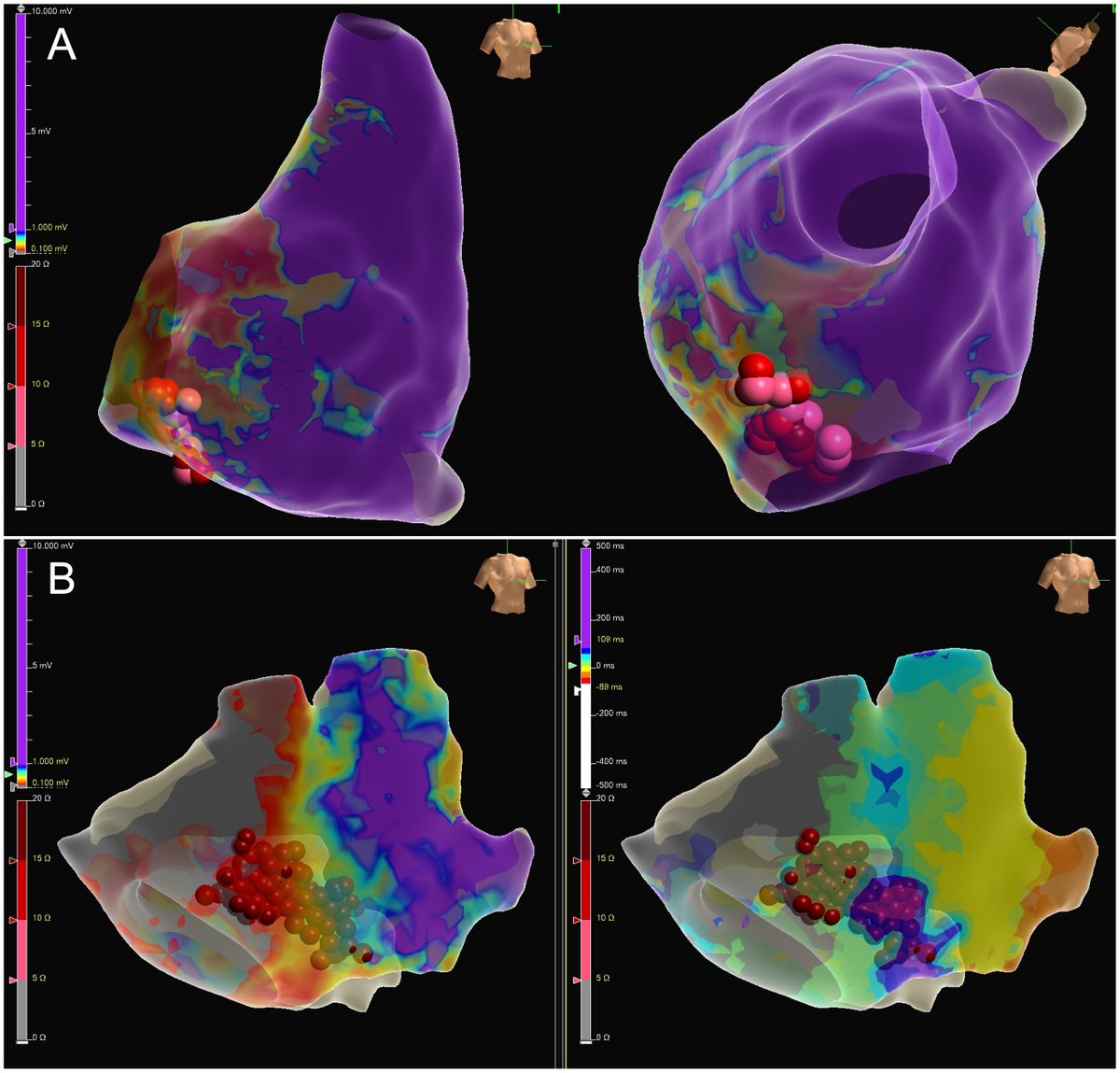Babken Asatryan, MD, PhD (@babkenasatryan) on Twitter photo Check out the latest #JACCCaseReports Editor’s Page by <a href="/JonChrispinMD/">Jonathan Chrispin</a> and me, highlighting key, can't-miss features that should raise suspicion for ARVC! #PrecisionMedicine <a href="/HopkinsMedicine/">Johns Hopkins Medicine</a> jacc.org/doi/10.1016/j.… Check out the latest #JACCCaseReports Editor’s Page by <a href="/JonChrispinMD/">Jonathan Chrispin</a> and me, highlighting key, can't-miss features that should raise suspicion for ARVC! #PrecisionMedicine <a href="/HopkinsMedicine/">Johns Hopkins Medicine</a> jacc.org/doi/10.1016/j.…