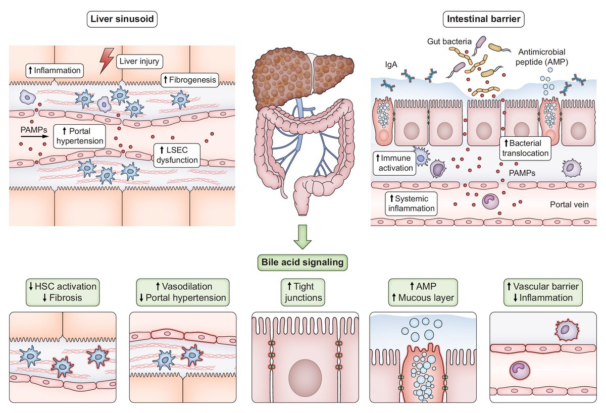 ReibergerThomas's tweet photo. @JHepatology 🥸
#Bile #Acid Metabolism & Signaling #LiverDisease
🔗https://t.co/4a3ypFoFMt
#cirrhosis #PortalHypertension➡️impaired #gut #vascular barrier➡️🦠translocation #PAMP ➡️
Liver sinusoids (#LSECs) sense damage, release inflammatory triggers to active #HSCs ➡️#fibrosis https://t.co/2WVRd3AHT8