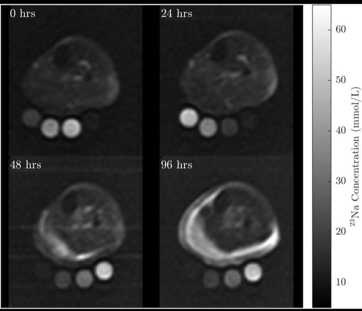 CSteward93's tweet image. Can sodium imaging be used to quantify muscle disruption after exercise? There appears to be a large increase in tissue sodium conc for some…
