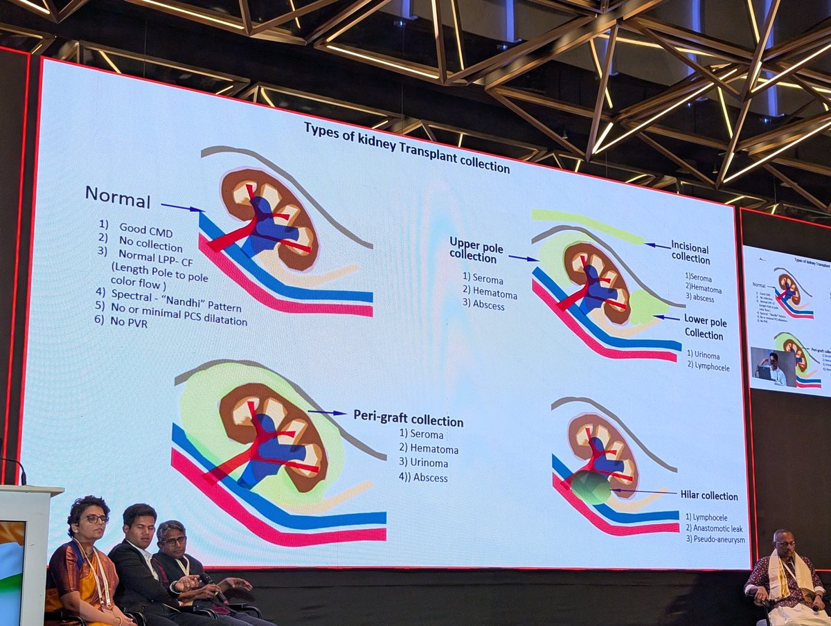 rajkbasudeo's tweet photo. @VelarvindS speaking on Role of imaging immediately post #kidney #transplant at ApEx #Pathshala24 @akforg https://t.co/Vv9liTbz70