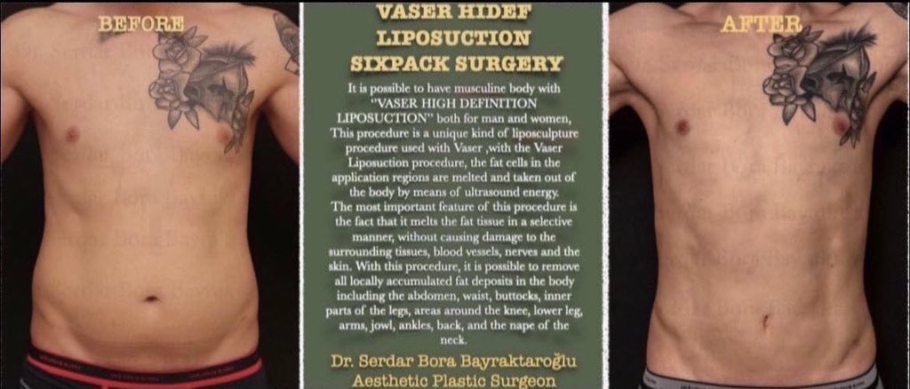 Clinicsbbintl's tweet photo. VASER HIDEF LIPOSUCTION SIXPACK SURGERY

You can have a more masculine body with liposuction and sixpack surgery

 #clinicsbbinternational #aestheticsurgery #plasticsurgery  #beforeafter #sixpacksurgery #vaserliposuction #vaserlipo #liposuction #vaserhidefliposuction https://t.co/ABNA7hdB7K