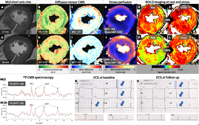 Betty Raman (@br_cmr) on Twitter photo First case demonstrating the marked beneficial effects of Aficamten, a cardiac myosin inhibitor, on myocardial energetics, perfusion and oxgenation in HCM after just 12 weeks of treatment. <a href="/Z_Ashkir/">Zakariye Ashkir</a> <a href="/OxfordBRC/">NIHR Oxford Biomedical Research Centre</a>
doi.org/10.1093/ehjci/… First case demonstrating the marked beneficial effects of Aficamten, a cardiac myosin inhibitor, on myocardial energetics, perfusion and oxgenation in HCM after just 12 weeks of treatment. <a href="/Z_Ashkir/">Zakariye Ashkir</a> <a href="/OxfordBRC/">NIHR Oxford Biomedical Research Centre</a>
doi.org/10.1093/ehjci/…