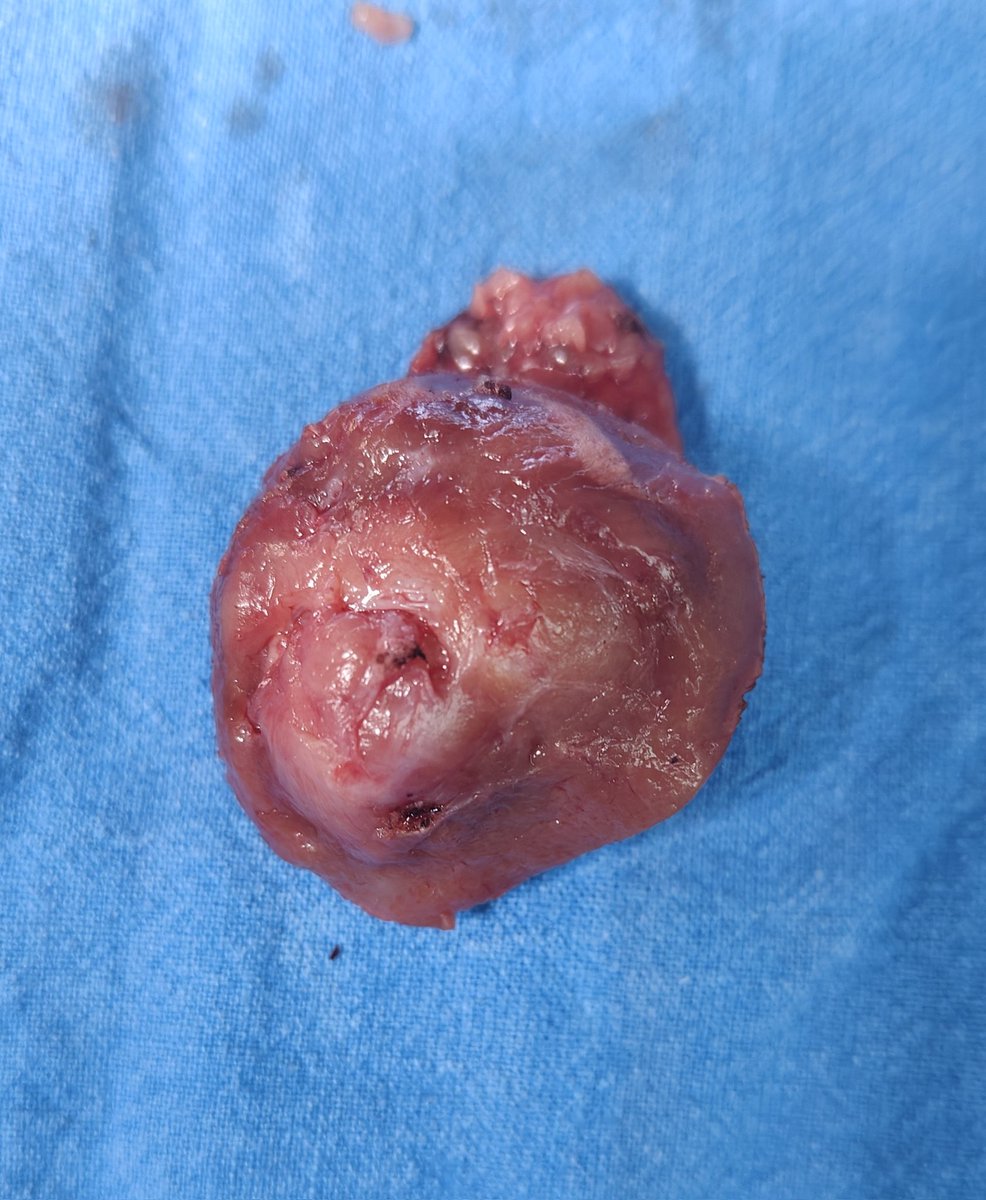 Dharmender Aggarwal (@dharmender8888) on Twitter photo Finally performed my first Robotic Retroperitoneal partial nephrectomy with console time of 75 minutes and WIT 14 minutes. Thanks to <a href="/DenosshanSri/">Denosshan Sri</a> <a href="/GeorgesUrology/">St George's Urology</a> for training me in this complex procedure... Planning to do more complex cases in future... #kidneycancer Finally performed my first Robotic Retroperitoneal partial nephrectomy with console time of 75 minutes and WIT 14 minutes. Thanks to <a href="/DenosshanSri/">Denosshan Sri</a> <a href="/GeorgesUrology/">St George's Urology</a> for training me in this complex procedure... Planning to do more complex cases in future... #kidneycancer
