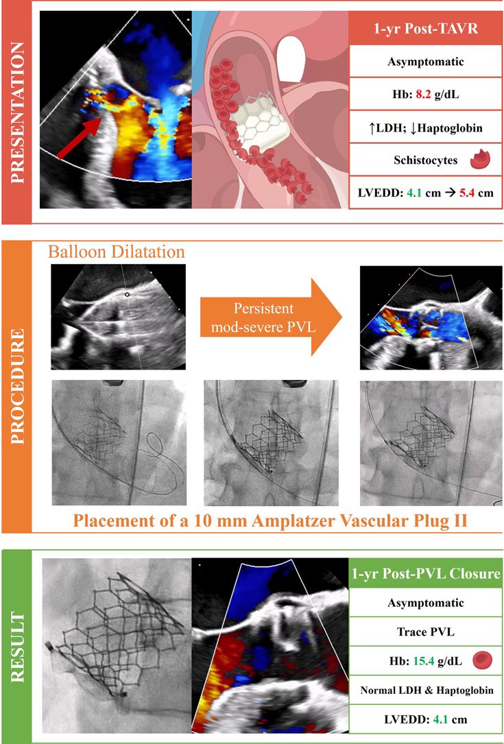 Jonathan Curio (@curiojonathan) on Twitter photo Very educative & nicely illustrated series on #TAVR #PVL + hemolysis by <a href="/MonteHeart/">Montefiore Heart</a> team in <a href="/JACCJournals/">JACC Journals</a> #JACCCR
🎯Distinct clinical presentations
➡️Plug based closure
➡️Resolution of hemolysis at f/u
🔗: jacc.org/doi/10.1016/j.… Very educative & nicely illustrated series on #TAVR #PVL + hemolysis by <a href="/MonteHeart/">Montefiore Heart</a> team in <a href="/JACCJournals/">JACC Journals</a> #JACCCR
🎯Distinct clinical presentations
➡️Plug based closure
➡️Resolution of hemolysis at f/u
🔗: jacc.org/doi/10.1016/j.…