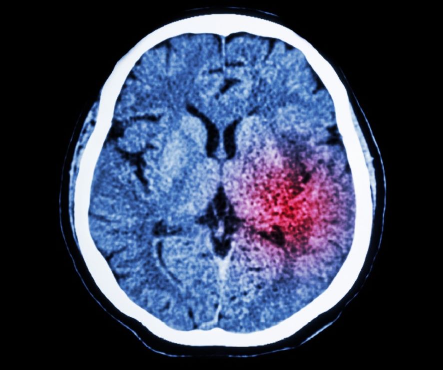 NeurologyToday's tweet image. Researchers say the #thrombectomy for #Stroke with Large Infarct on Non-contrast CT trial offers true-to-life findings: bit.ly/4fZNdZo

#NeuroTwitter @AANMember @oozaidat @UCalgaryMed @AJagolinoCole